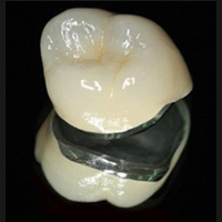 зубные коронки из металлокерамики