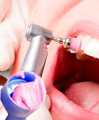 фторирование зубов