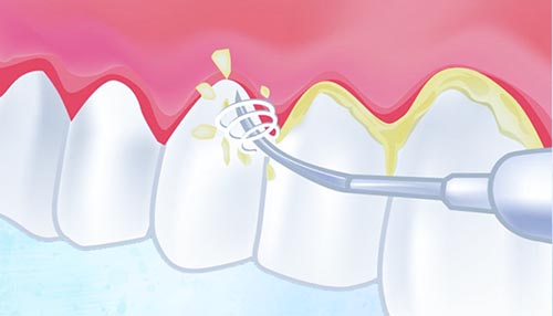 ультразвуковая чистка зубов цена