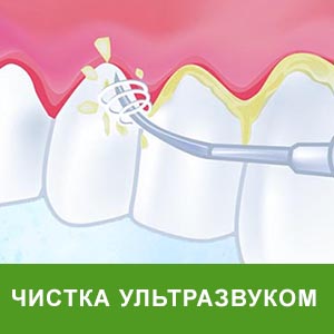 ультразвуковая гигиена полости рта